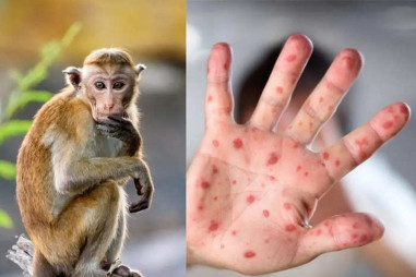 Virus gây bệnh đậu mùa khỉ tiếp tục lây lan